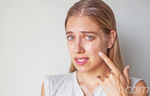 赤ら顔 原因 アレルギー